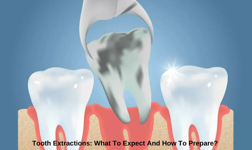 Tooth extractions