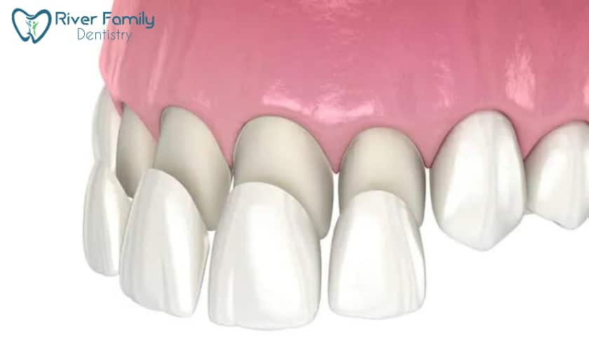 Porcelain Veneers