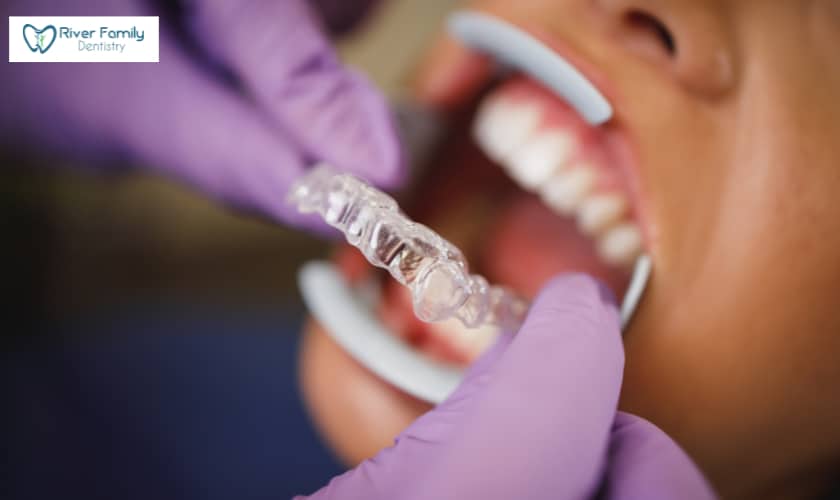 Benefits of Invisalign and Clear Aligners