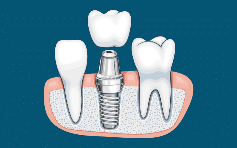 Featured image for “A Comprehensive Guide to Caring for Your Dental Implants”