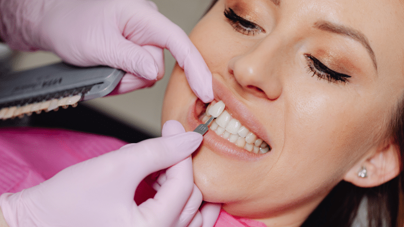 how many no-prep veneers does your smile need