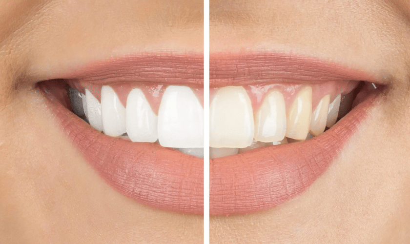 teeth whitening in Goldriver
