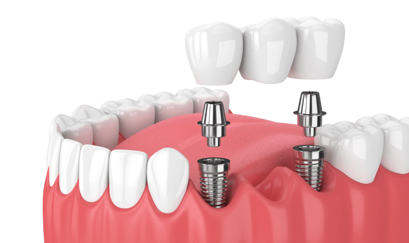 Featured image for “ How To Care For Your Dental Implants: Tips And Tricks”