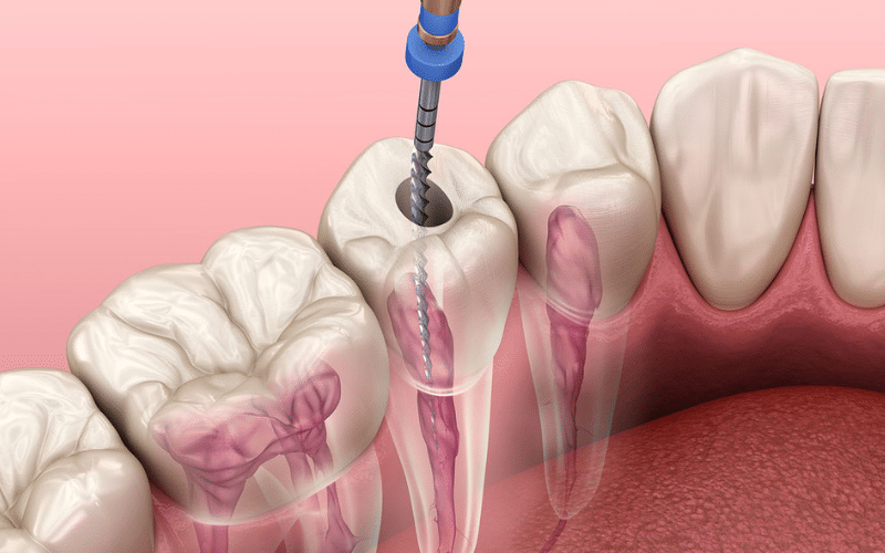 Featured image for “The Ultimate Guide To Post-Root Canal Nutrition”