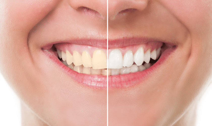 teeth whitening goldriver