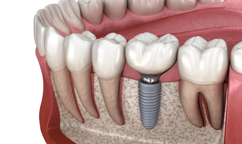 The Ultimate Guide to Dental Implants Benefits and What to Expect