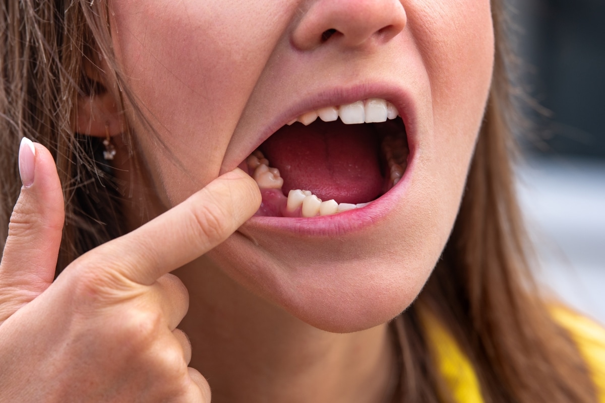 Featured image for “Dry Socket After Tooth Extraction: How to Prevent & Home Care Guide”
